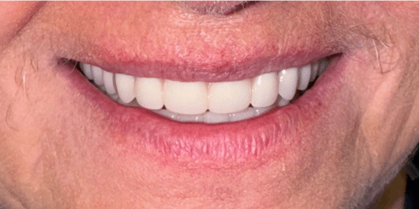 Dental Implants After