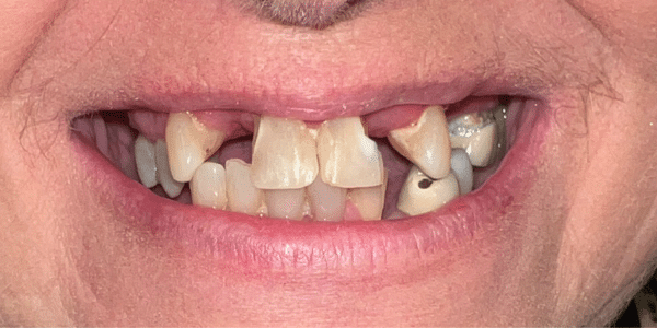Dental Implants Before